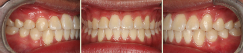 After photo (front view of teeth): Underbite, Case Study #4
