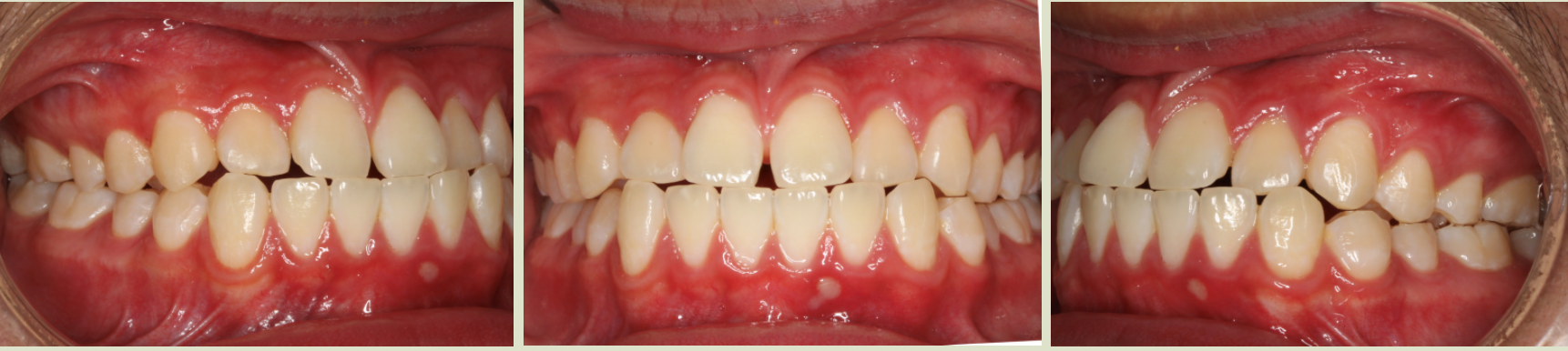 Before photo (front view of teeth): Underbite, Case Study #4