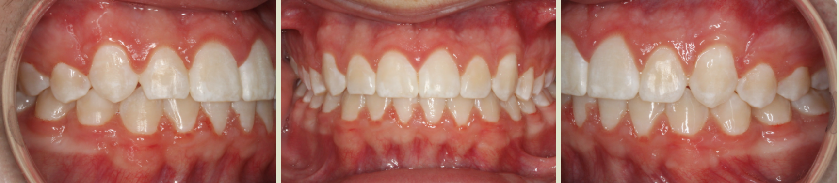 After photo (front view of teeth): Severe Dental Crowding - Palate Expander & Braces, Case Study #5
