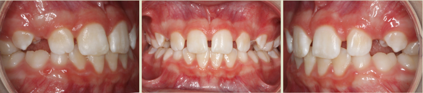 Before photo (front view of teeth): Severe Dental Crowding - Palate Expander & Braces, Case Study #5