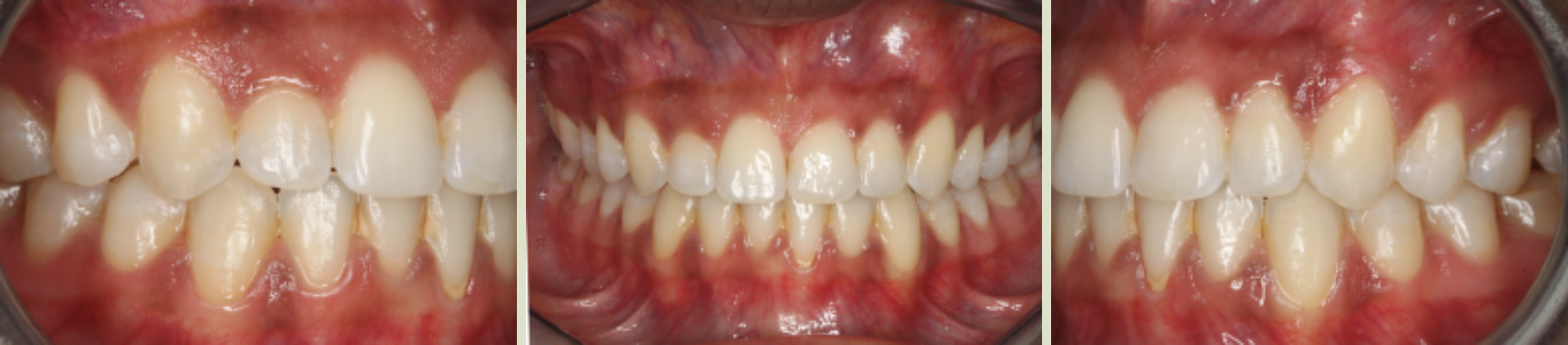 Invisalign Case Study 6: After clear aligner treatment with retainer, view of front teeth