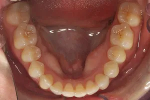 Invisalign Case Study 5: After clear aligner treatment with retainer, lower jaw
