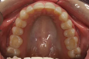 Invisalign Case Study 5: After clear aligner treatment with retainer, upper jaw