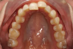 Invisalign Case Study 5: Before clear aligner treatment with retainer, upper jaw