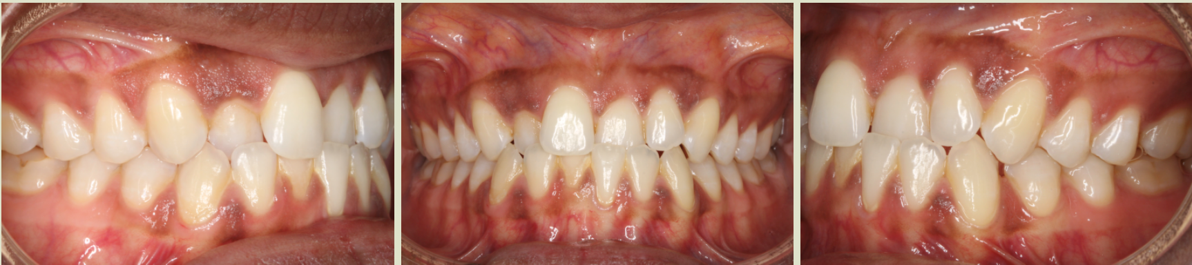 Invisalign Case Study 6: Before clear aligner treatment with retainer, view of front teeth