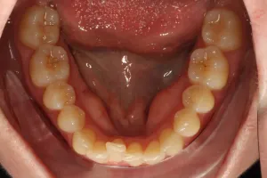 Invisalign Case Study 5: Before clear aligner treatment with retainer, lower jaw