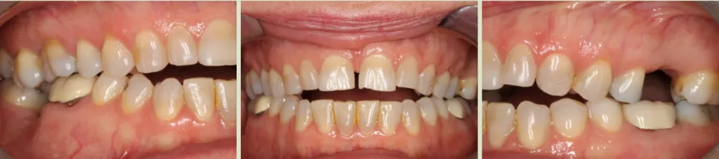 Invisalign Case Study 6: Before clear aligner treatment with retainer to fix anterior open bite