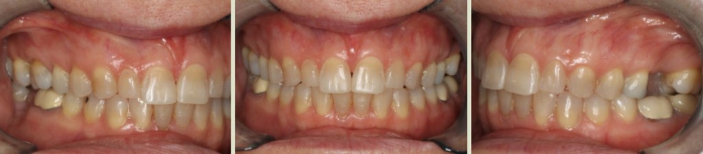 Invisalign Case Study 6: After clear aligner treatment with retainer to fix anterior open bite