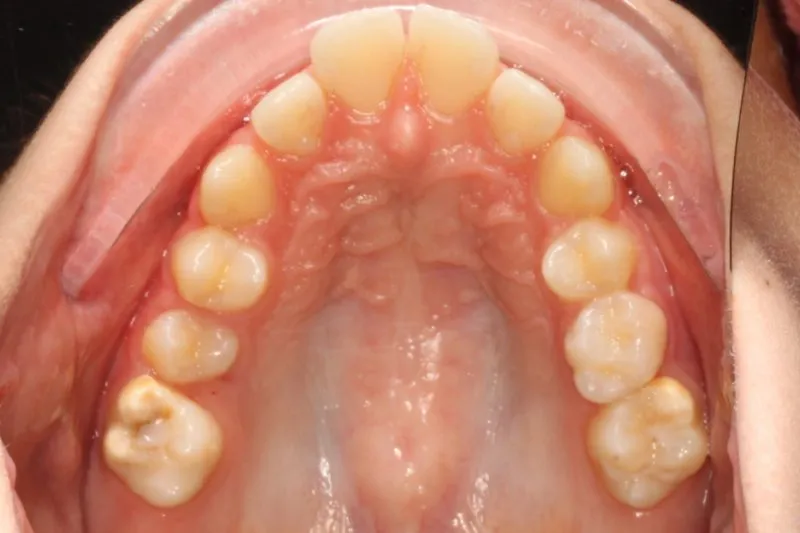 Before photo: Flared upper teeth
