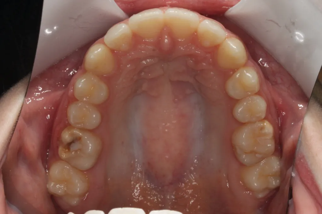 After photo: Straightened upper teeth