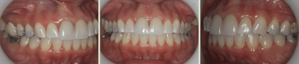 Invisalign Case Study 6: Before clear aligner treatment with retainer, view of front teeth