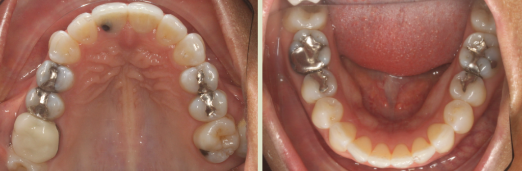 Invisalign Case Study 2: Before clear aligners with crooked, crowded teeth, lower jaw