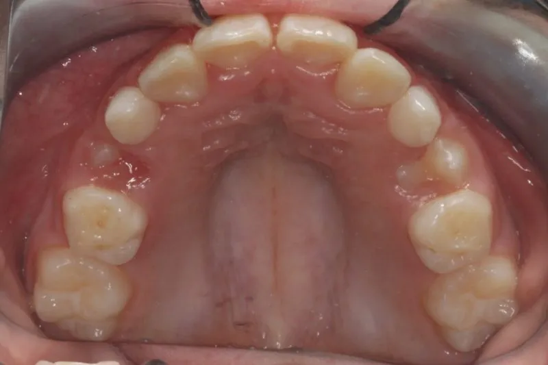 After photo: Straightened upper teeth