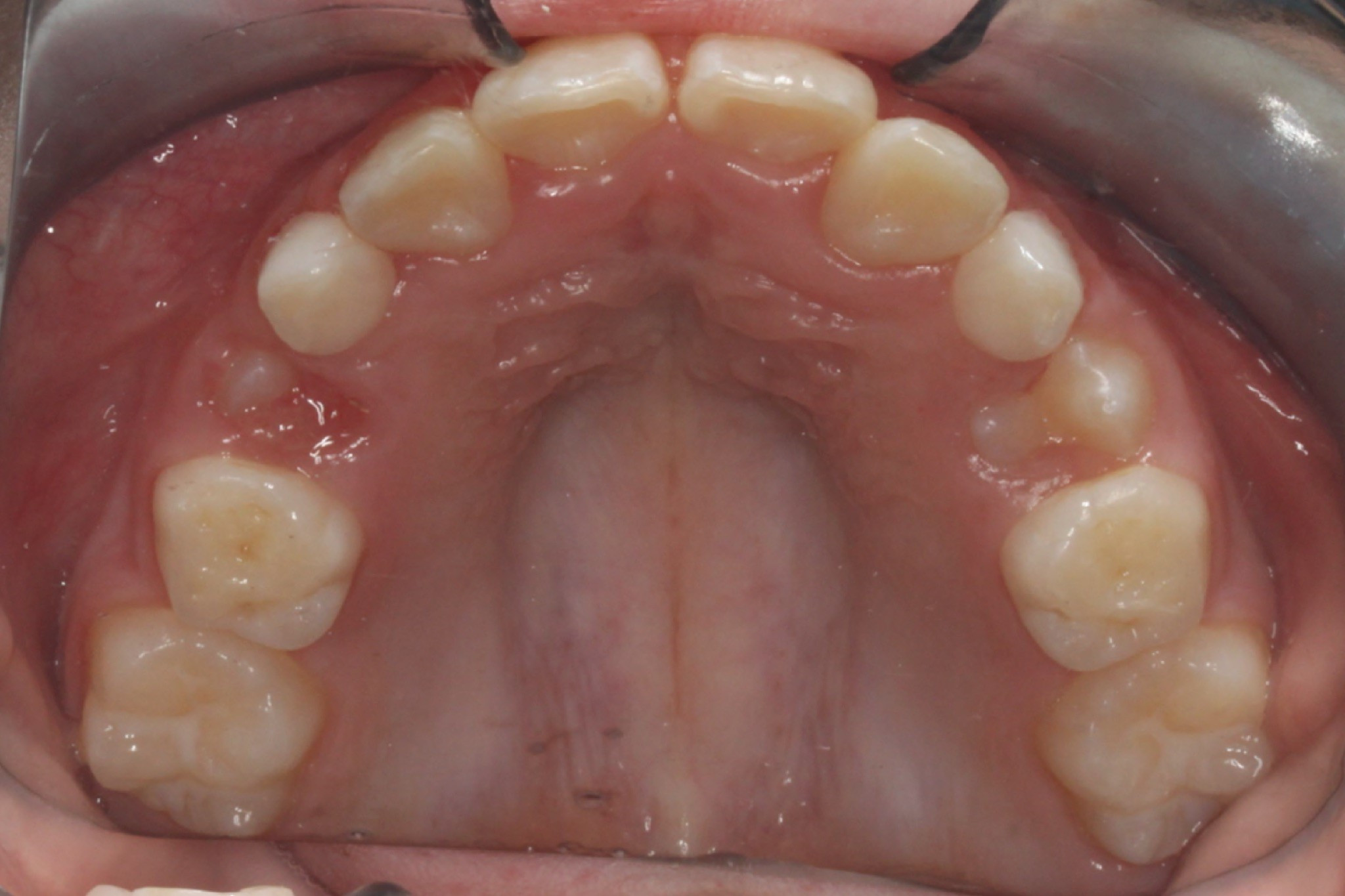 After photo: Straightened upper teeth