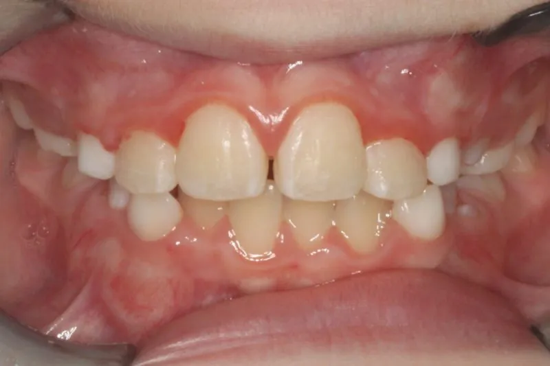 Spacing issues with gaps in upper teeth