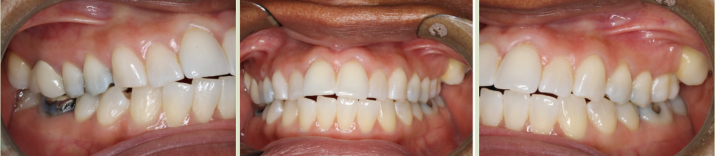 Invisalign Case Study 6: Before clear aligner treatment with retainer to fix anterior open bite