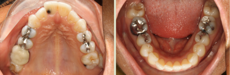 Invisalign Case Study 2: Before clear aligners with crooked, crowded teeth, lower jaw
