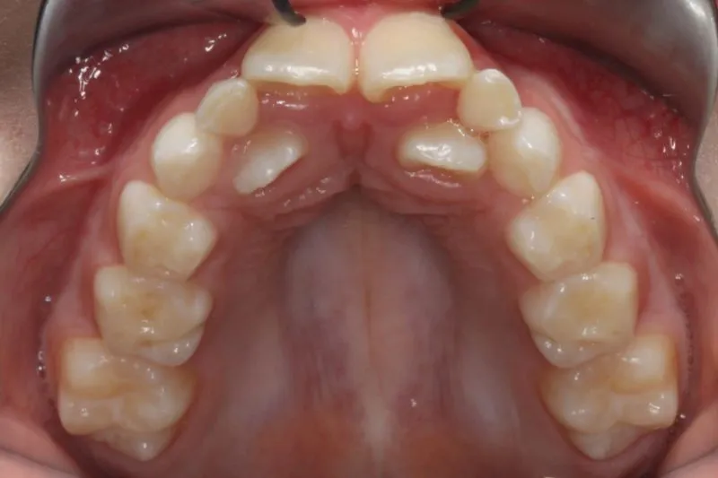 Before photo: Flared upper teeth