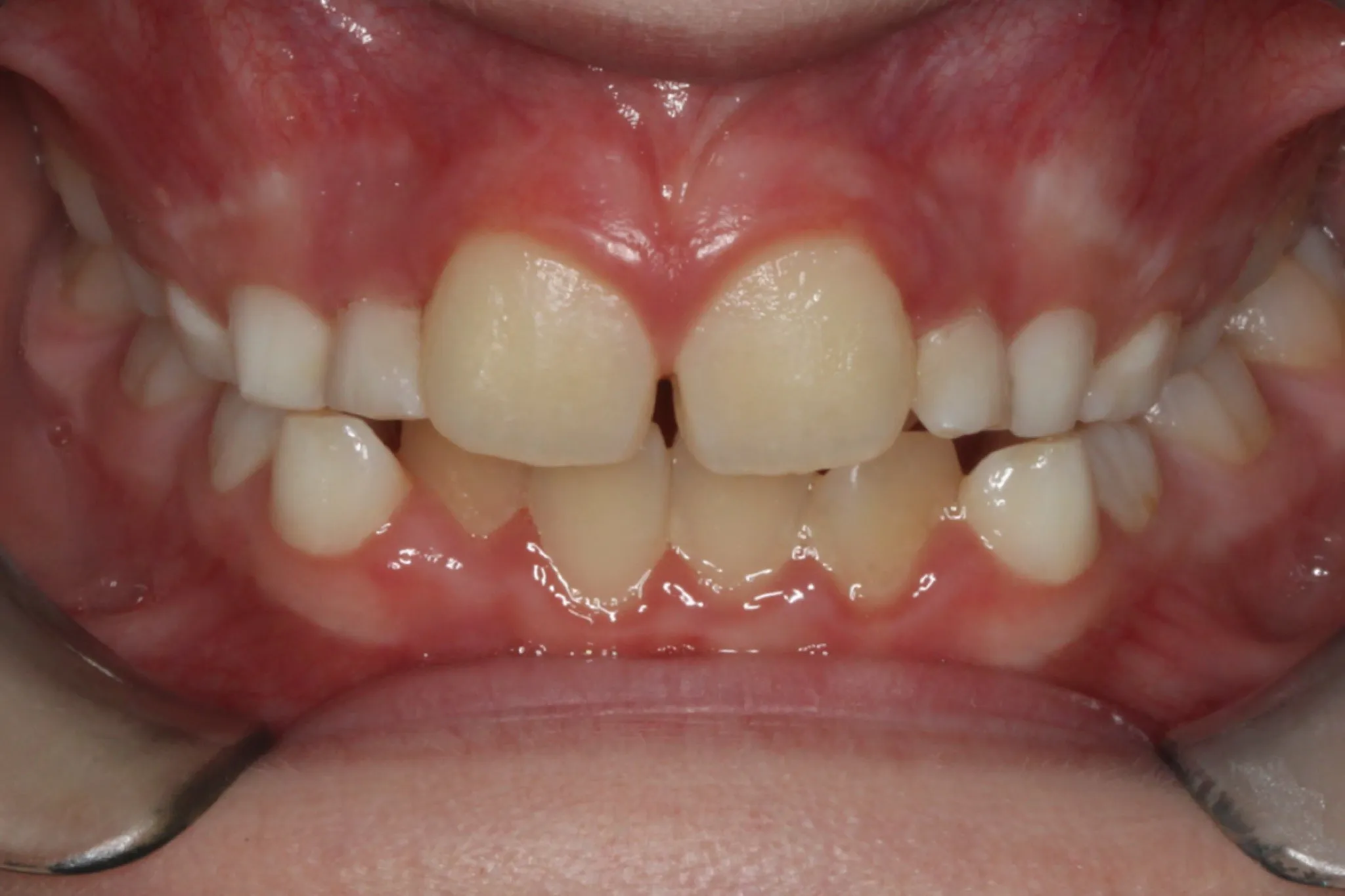 Spacing issues with gaps in upper teeth