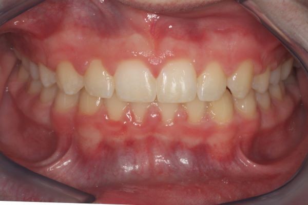  After photo (front view of teeth): Invisalign for Crowding & to Widen Arches, Case Study #1