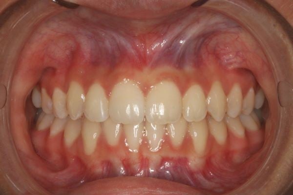 After photo (front view of teeth): Invisalign for Crowding & to Widen Arches, Case Study #1