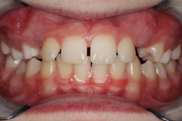 Spacing issues with gaps in upper teeth