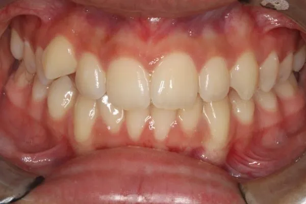 After photo (front view of teeth): Invisalign for Crowding & to Widen Arches, Case Study #1